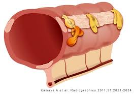 Apendicitis Epiploica: Causas. Guía De Cirugía De Vanguardia Apendagitis Apendicitis Epiploica: Causas