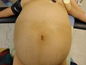 Abdomen Agudo Tipo Obstructivo: Guía Clínica Urgente Dsc029881 Abdomen Agudo Tipo Obstructivo