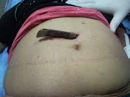  Trauma De Abdomen