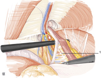 Eficaz Operación De Hernia Inguinal. Técnicas Y Recuperación 🚀 Hernia Inguinal Diagrama Anatómico De Hernia Inguinal De Contenido Graso Y Lipoma Del Cordón Espermático