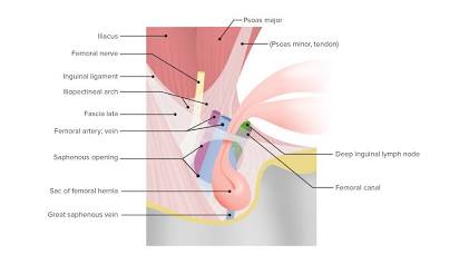 Diagrama Anatómico De Hernia Femoral En La Mujer Con El Saco Herniario En El Canal Crural