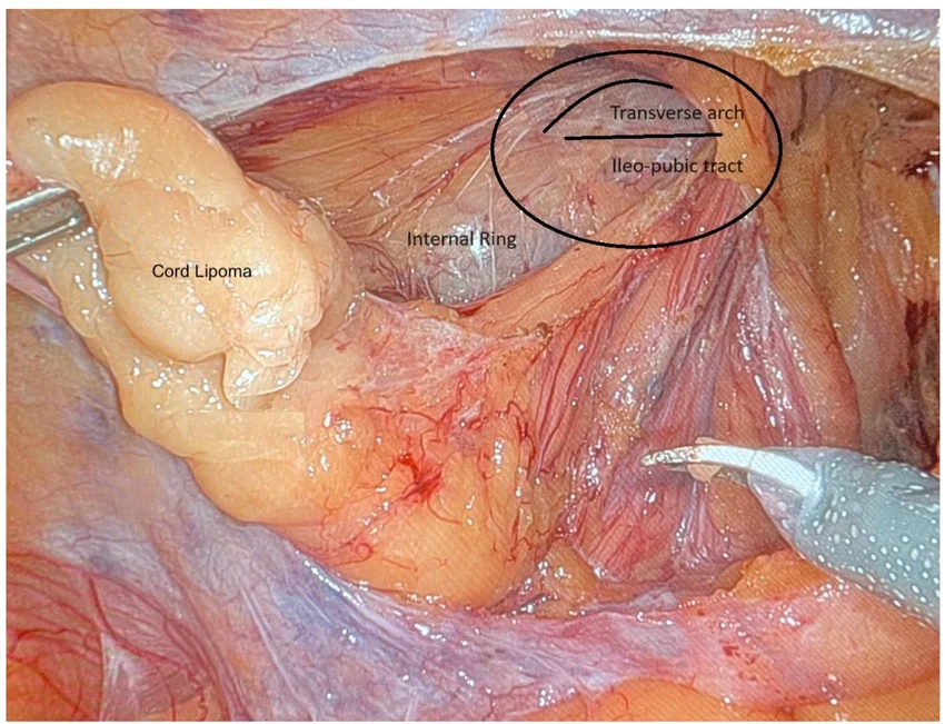 Lipoma De Cordon Espermatic Dr Jorge Delgado Cirujano