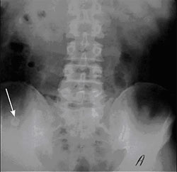 Radiografía Simple De Abdomen Mostrando Un Apendicolito Calcificado Radiopaco En La Fosa Ilíaca Derecha