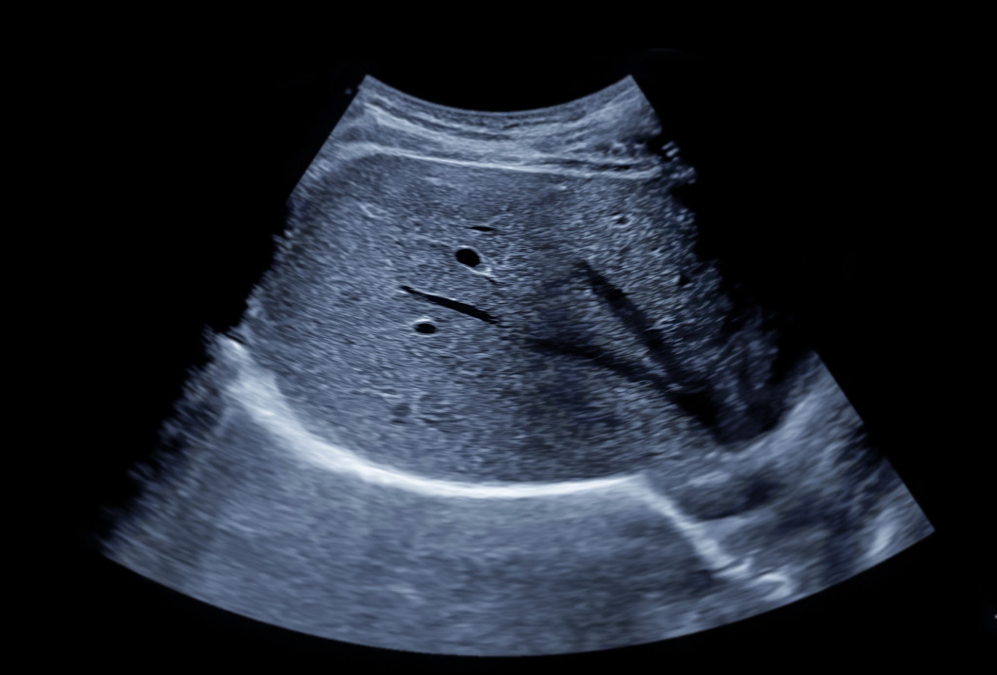 Hepatized Gallbladder on Ultrasound