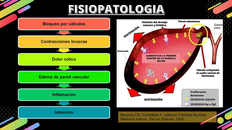 Diagrama Fisiopatológico De Vesícula Biliar Reventada Mostrando Oclusión Por Cálculo, Isquemia Y Perforación