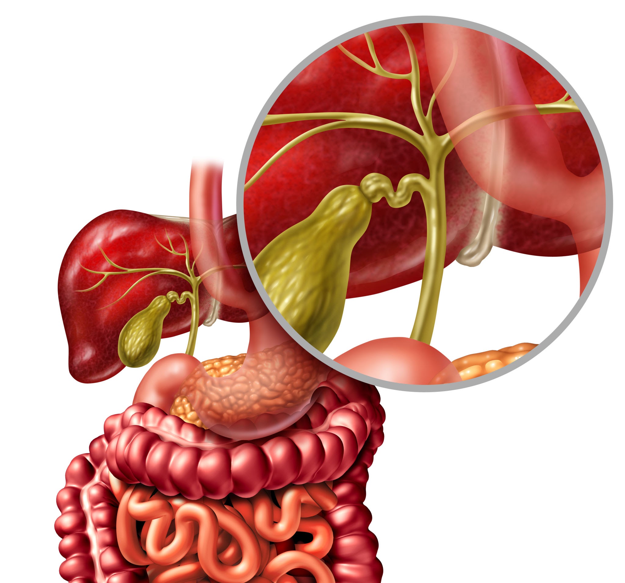 Vesícula Biliar Llena De Piedras. Causas, Riesgos Y Cirugía 🎯 Vesicula Llena De Piedras Diagrama Anatómico De La Vesícula Biliar Y Vías Biliares Mostrando Litos Y Colelitiasis