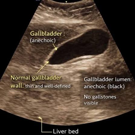 Ecografía Abdominal Mostrando Vesícula Con Paredes Finas Normales Menores A 3 Mm