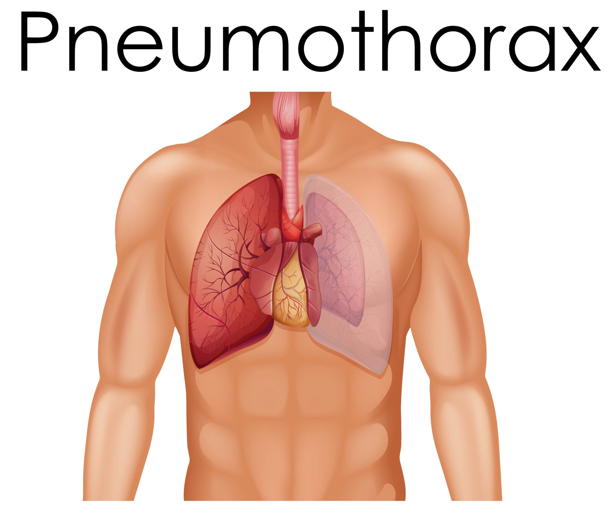 Traumatismo En El Tórax. Evaluación Atls Y Manejo 🚀 Ilustración Médica De Neumotórax Y Colapso Pulmonar Por Traumatismo En El Tórax