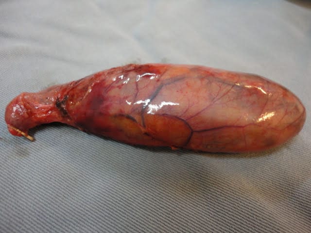 Cirugía Por Colecistitis Aguda En La Mujer (Colecistectomía - Múltiples Cálculos) - Resultados Y Tratamiento Por El Dr. Jorge Delgado.