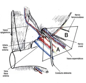 Hernia En La Ingle Izquierda: Guía De Vanguardia Médica. Region Inguinal Cara Posterior A Triangulo Vascular Doom B Triangulo Nervioso Del Region-Inguinal-Cara-Posterior