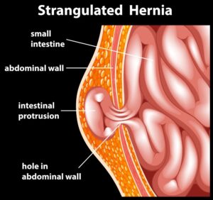 Hernia Notable En La Ingle