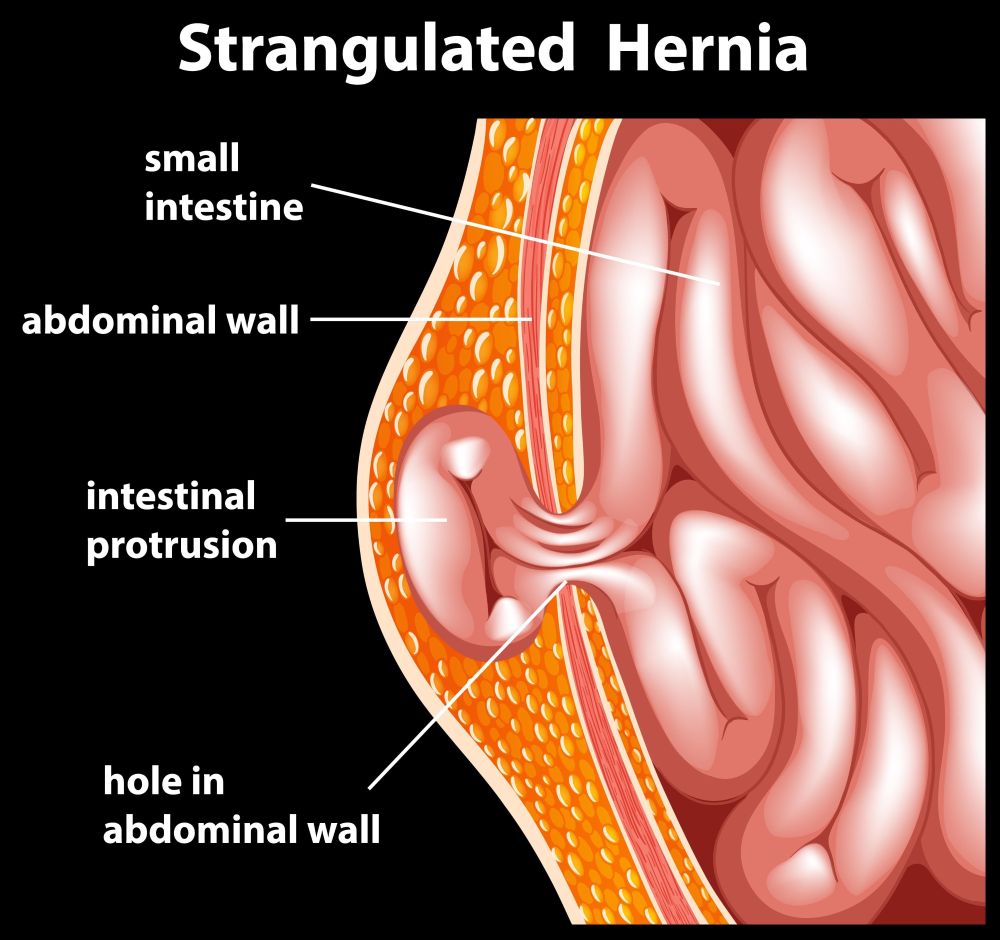 Hernia Inguinal De Bulto Duro: Guía Notable Preventiva Hernia Estrangulada Image1 Hernia Notable En La Ingle