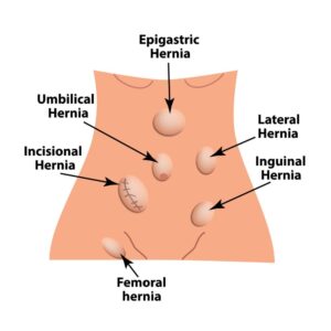 Hernia Por Laparoscopia: Hoy La Cirugía De Vanguardia. Tipos De Hernias1 Hernia Por Laparoscopia