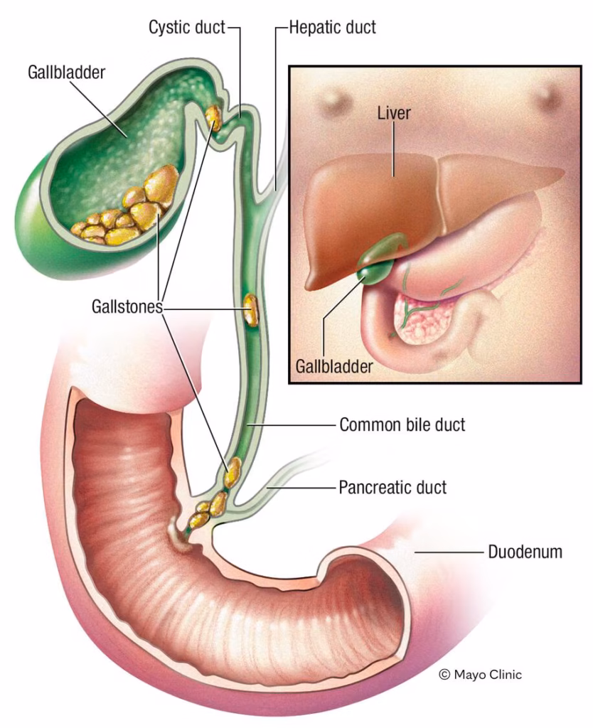 ¿Sirve El Té Para Piedras En La Vesícula? Riesgos 👨⚕️ Calculosbiliares Anatomía De Las Vías Biliares